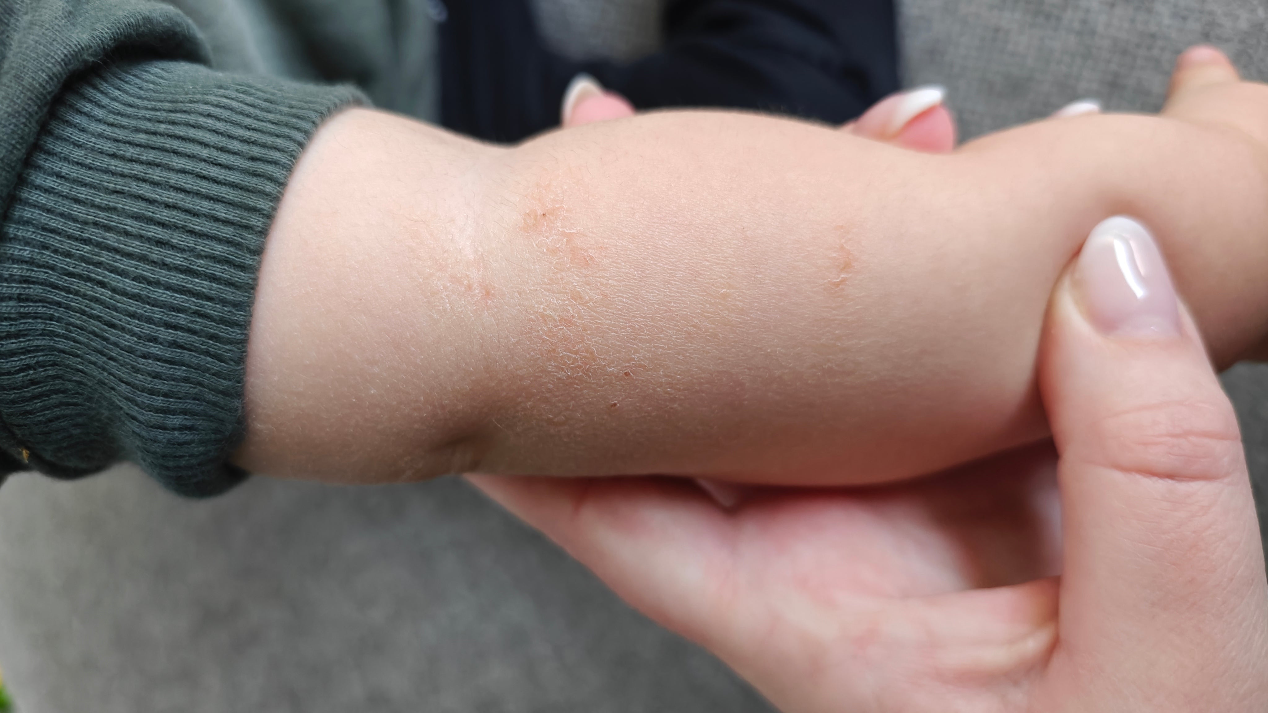 Wat helpt bij jeuk door droge huid?